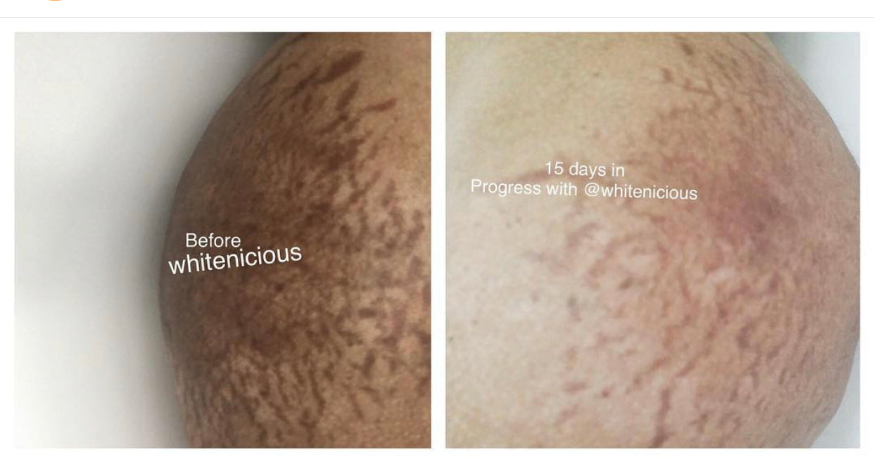 Intensive Stretch Mark Reduction Cream