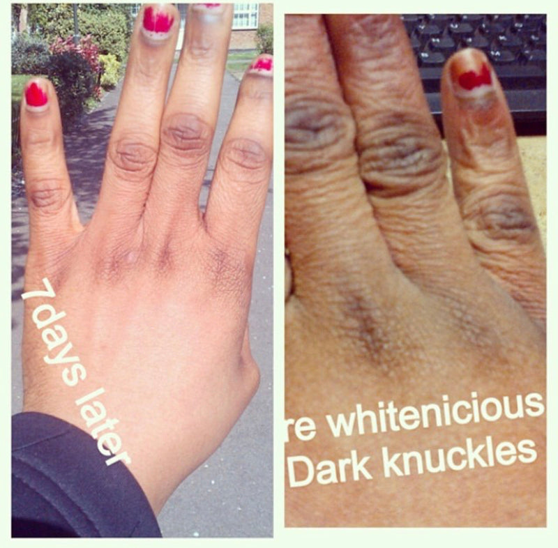 Dark Knees,knuckles & Elbows Lightening Cream 200G